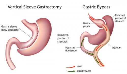 Bypass g�strico